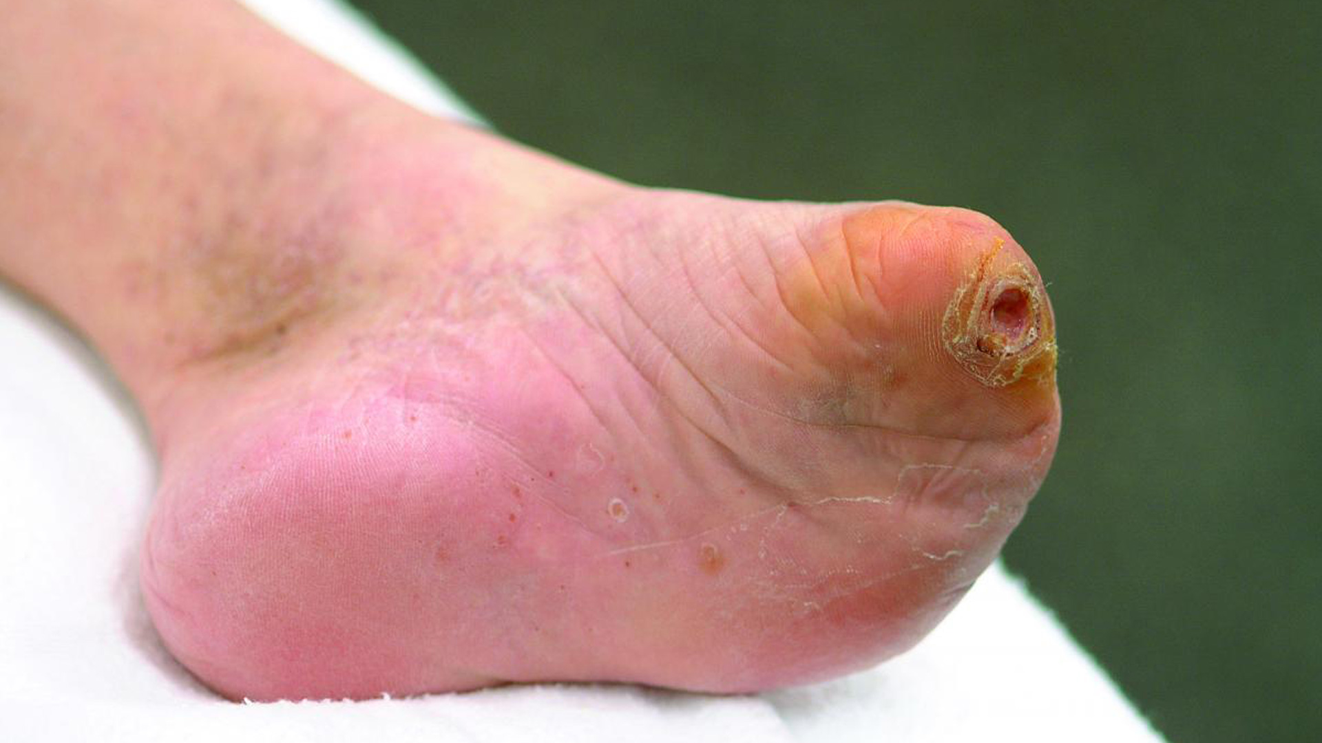 toe amputee