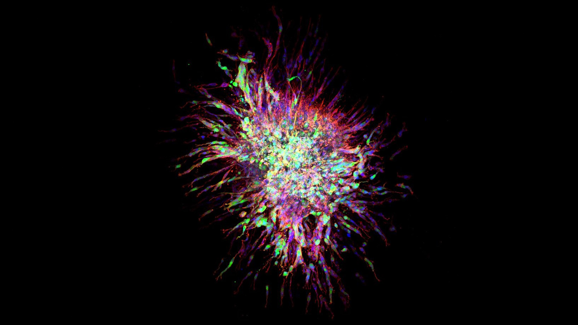 Immunofluorescence microscopy image of brain tumour spheroid